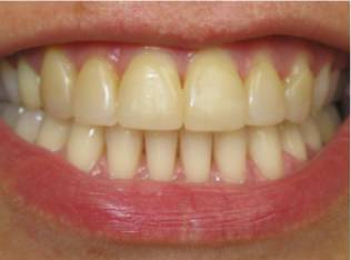 teeth-whitening-before